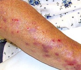 calciphylaxis symptoms