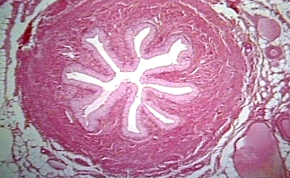 Cancer of the ureter
