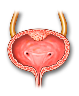 Cancer of the ureter