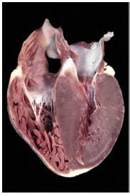 Cardiomyopathy | Australia| PDF | PPT| Case Reports ...
