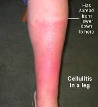 Cellulitis Australia Pdf Ppt Case Reports Symptoms Treatment
