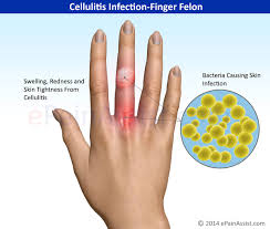 Cellulitis