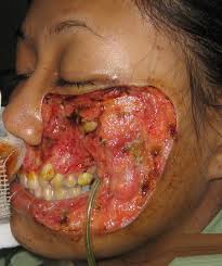 Treatment of facial cellulitis have For the Treatment of facial cellulitis consider