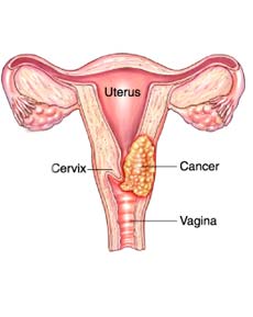 Cervical cancer