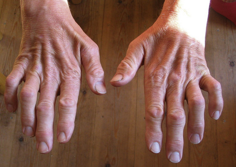 Charcot-Marie-Tooth disease