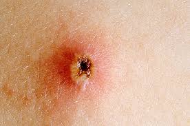 pix Chicken Pox In Adults Mild chickenpox germany pdf ppt case