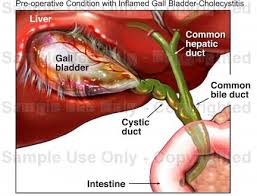 Cholecystitis | Singapore| PDF | PPT| Case Reports ...