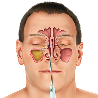 sinusitis chronic spain symptoms treatment mucus disease rhinosinusitis