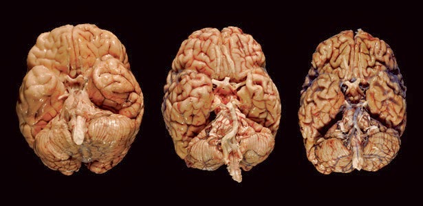 How Cte Chronic Traumatic >> Chronic Traumatic Encephalopathy Australia Pdf Ppt How Cte Chronic Traumatic >> Chronic Traumatic Encephalopathy Australia Pdf Ppt
