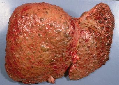 cirrhosis mexico pdf ppt case reports symptoms treatment