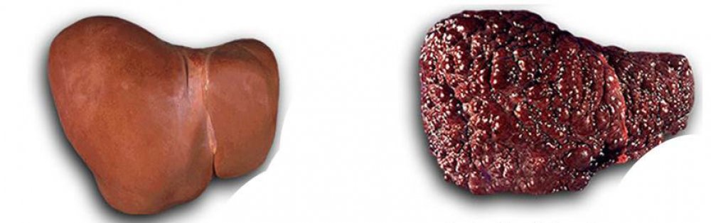 cirrhosis netherlands pdf ppt