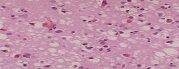 Classic Creutzfeldt Jakob Disease