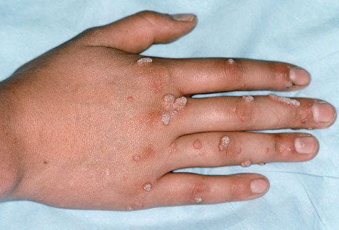Human papillomavirus common warts Recomandări clinice de hookworm