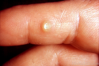 human papillomavirus induced warts