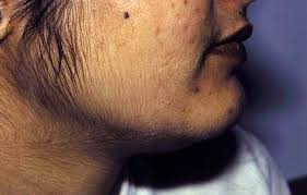 hyperplasia adrenal congenital