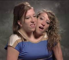 conjoined twins australia pdf ppt case reports symptoms how to twins form