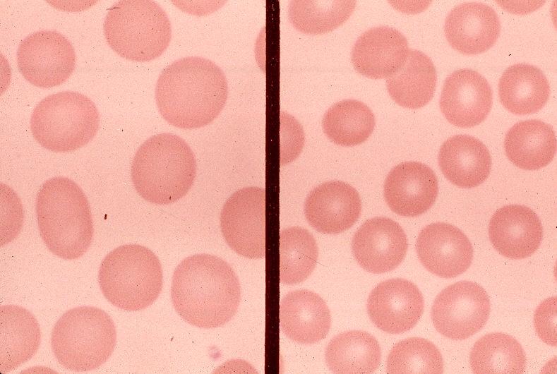 Cooleys Anemia Belgium PDF PPT Case Reports Symptoms Treatment