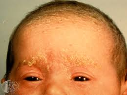 selsun blue for infant cradle cap