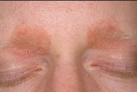 t gel for cradle cap