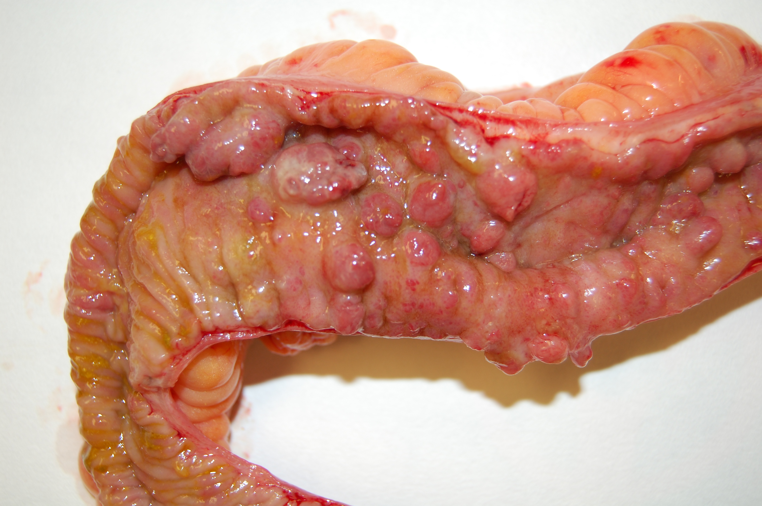 Crohns disease