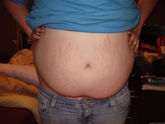 Cushing Syndrome | Belgium| PDF | PPT| Case Reports | Symptoms | Treatment