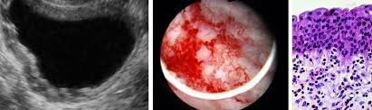 mild chronic cystitis