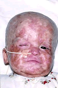 for rash paracetamol Argentina   Cytomegalovirus PDF  Reports  PPT Case