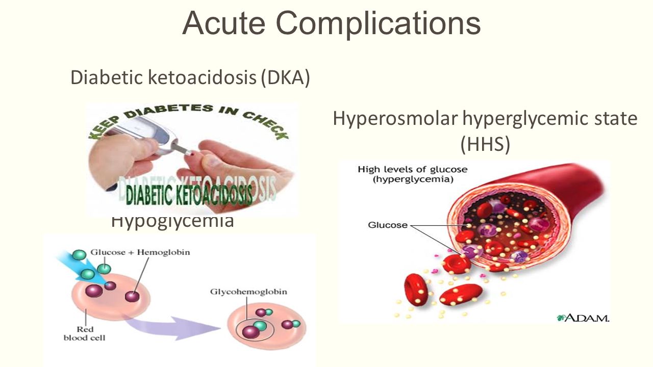 diabetic hyperosmolar syndrome