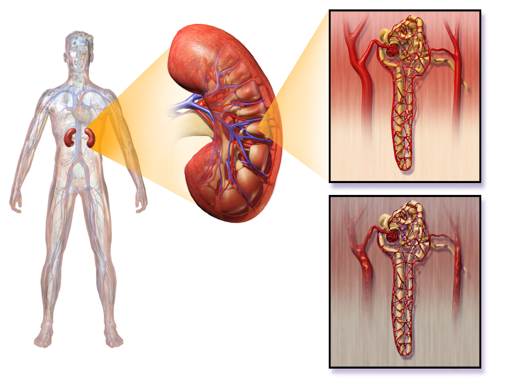 Az id‘skori vesebetegs©gek kih­vsai: hypertonia , dyslipidaemia