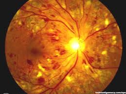 diabetic retinopathy treatment ppt