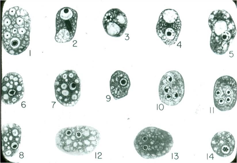 Dientamoeba Fragilis Treatment Diet