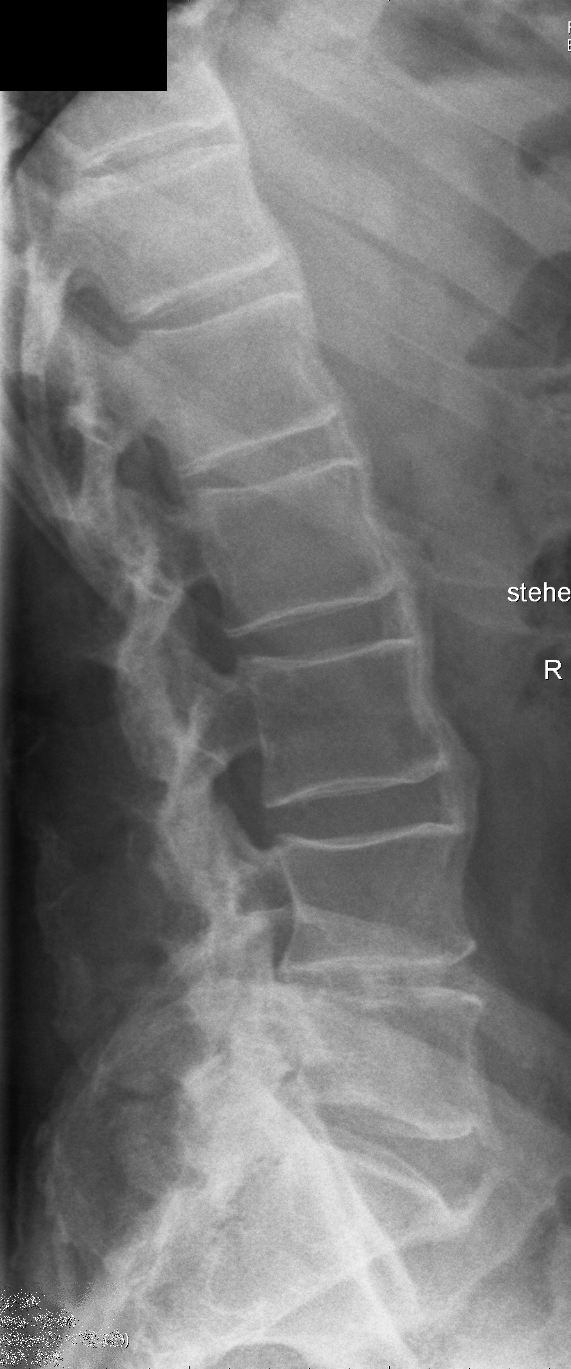 Diffuse idiopathic skeletal hyperostosis