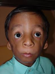 DiGeorge Syndrome Singapore PDF PPT Case Reports DiGeorge Syndrome Singapore PDF PPT Case Reports