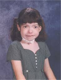 famous people with digeorge syndrome