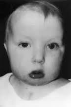 digeorge syndrome mexico pdf