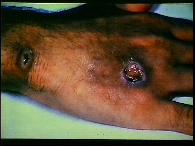 Diphtheria | Norway| PDF | PPT| Case Reports | Symptoms | Treatment
