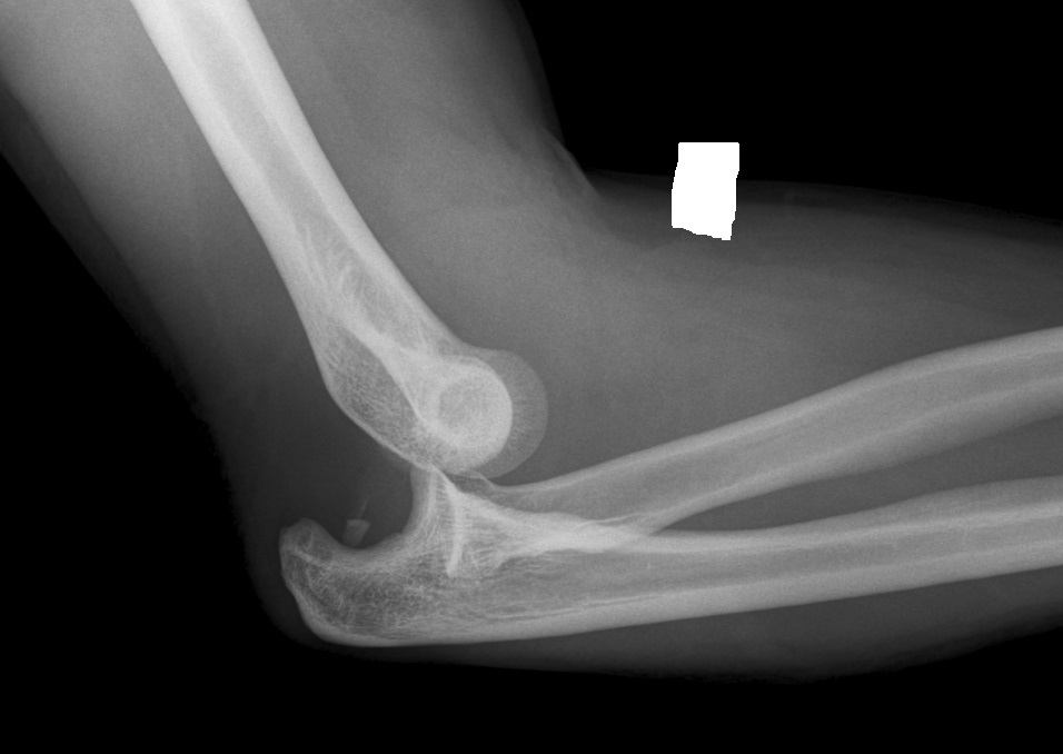 Dislocated elbow Norway PDF PPT Case Reports Symptoms Treatment