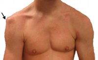 signs of a broken collarbone signs of a broken collarbone