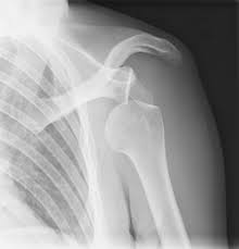 Dislocated shoulder