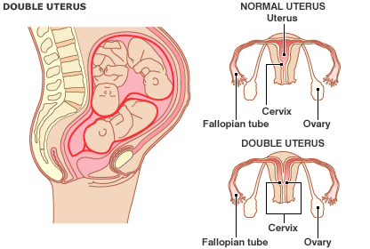 Double uterus