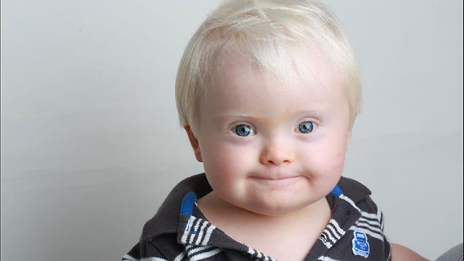 Down Syndrome | United States| PDF | PPT| Case Reports | Symptoms