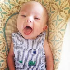 down syndrome features