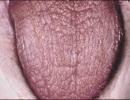 Xerostomia In Elderly