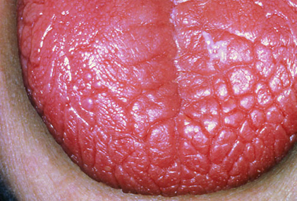sjogren s cracked tongue disease