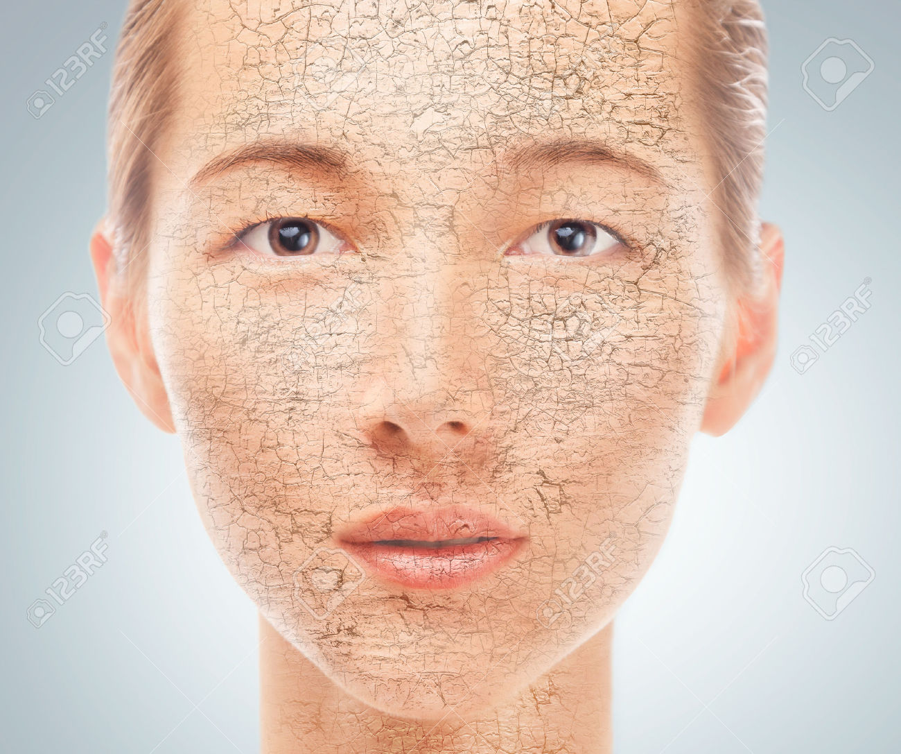 Dry Skin Brazil Pdf Ppt Case Reports Symptoms Treatment