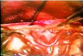 Dural arteriovenous fistulas