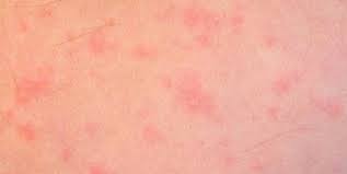 Dust mite allergy | Japan| PDF | PPT| Case Reports