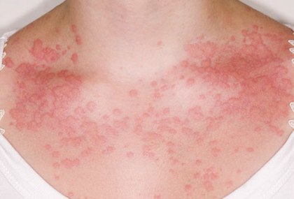 Dust mite allergy