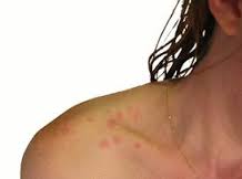 Dust Mite Allergy Mexico Pdf Ppt Case Reports Symptoms Treatment