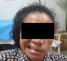 dysarthria